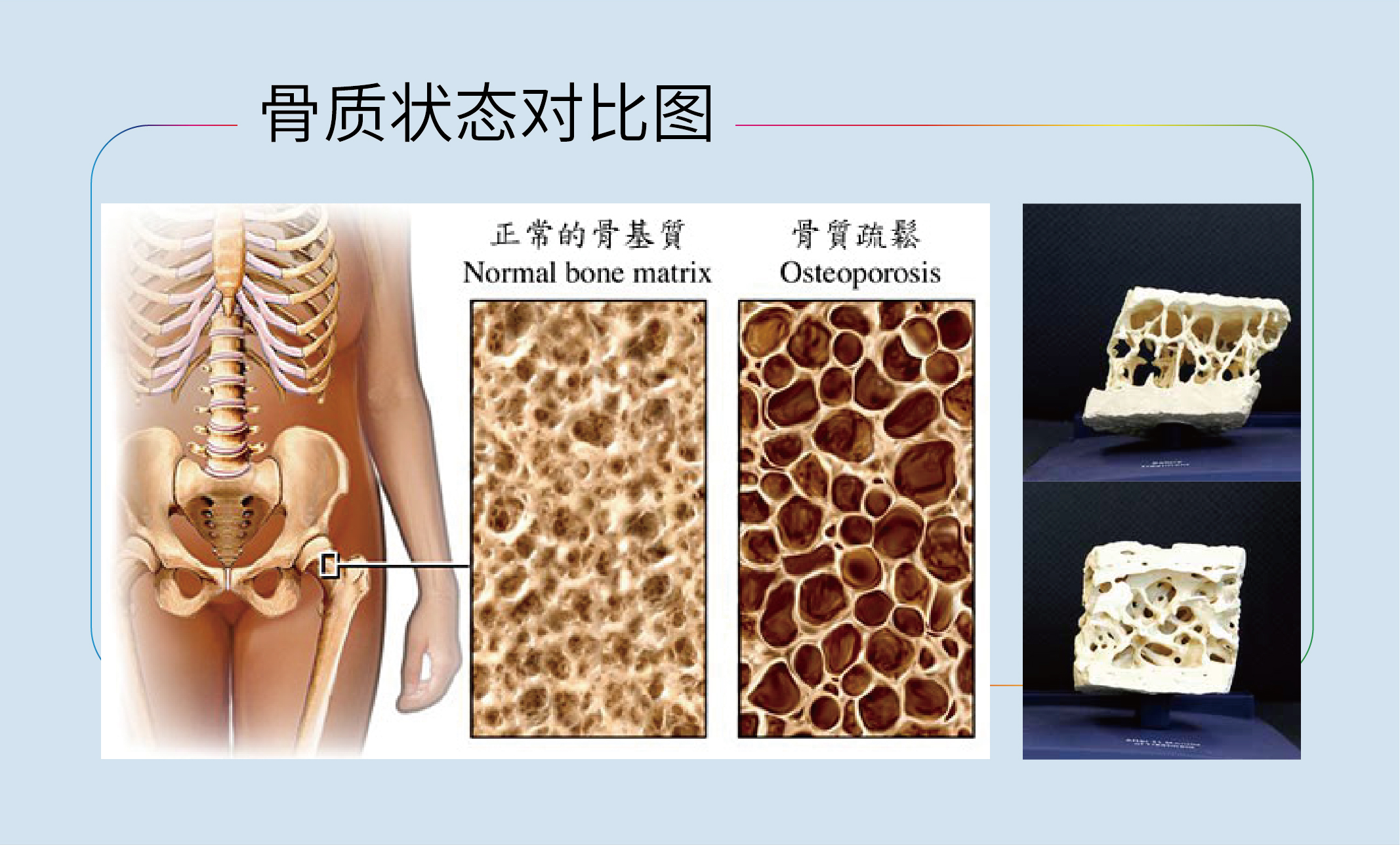  天门冬氨酸钙_关于钙的正常骨质与骨质疏松对比图